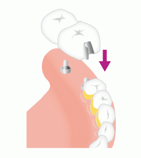 アタッチメント義歯のしくみ