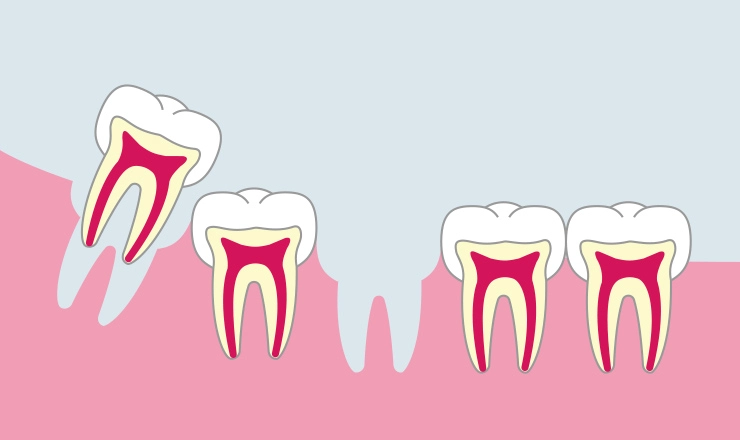 親知らずや小規模手術に対応しています