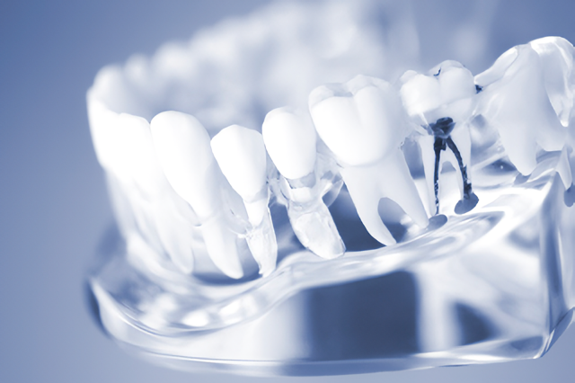 歯を守るための基本治療を丁寧に