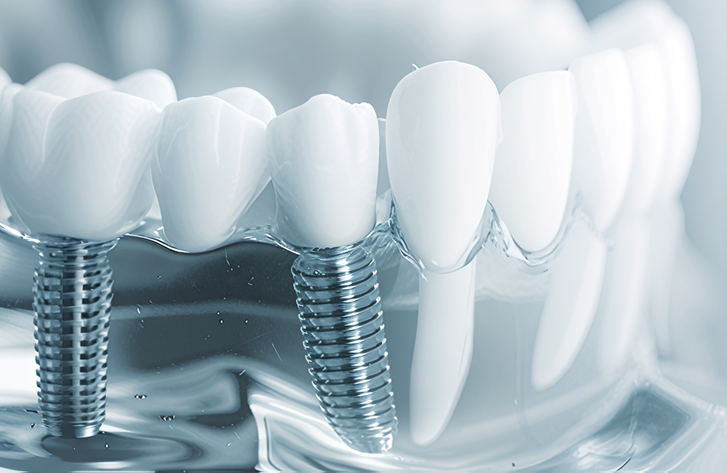 精密診断と骨造成対応で安全・確実なインプラント治療を実現