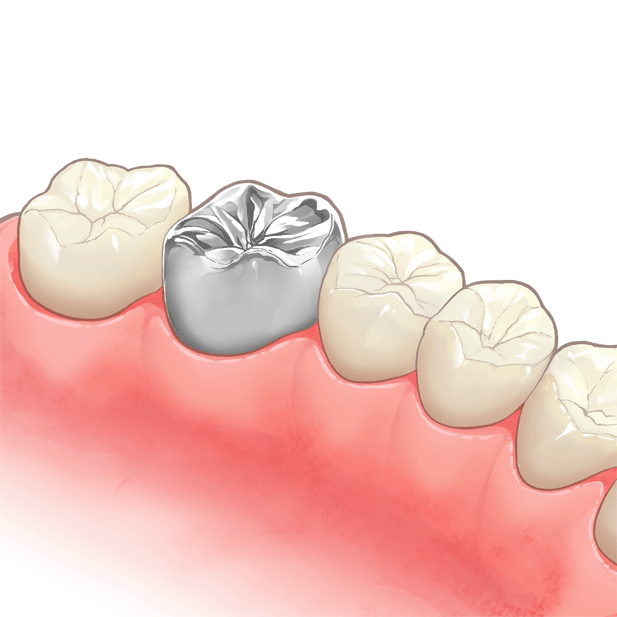 失った歯を補い笑顔を取り戻すお手伝い
