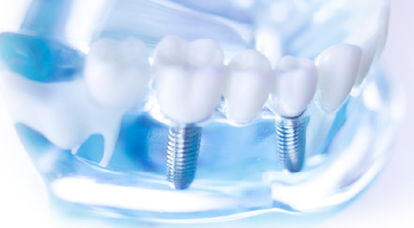 噛む力を失っていた方でも、食事を再び楽しむことができ、日常生活に戻ることが可能になります。