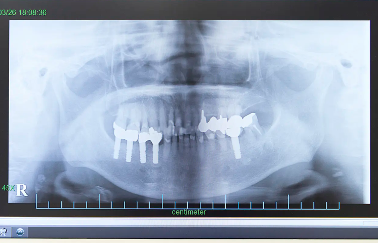 CTと20年の技術が支える、確かなインプラント治療
