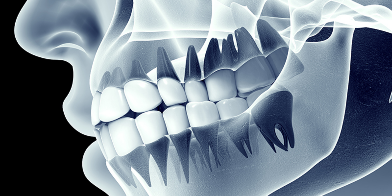 噛み合わせやストレス、歯ぎしりや事故による強い衝撃なども原因の一つ