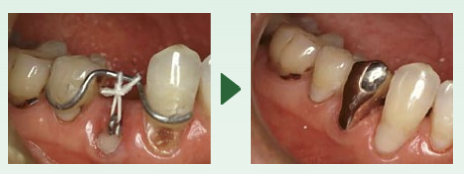 抜歯しない治療法