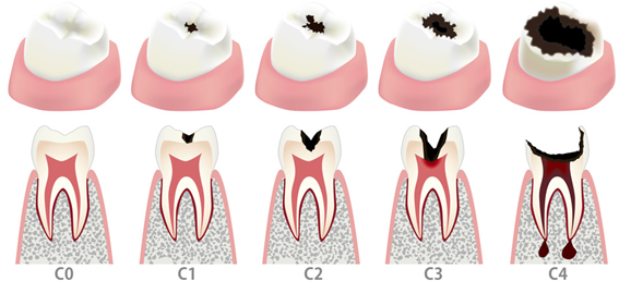 気づいた時には歯を失ってしまうこともあるため、早期の対応が重要です