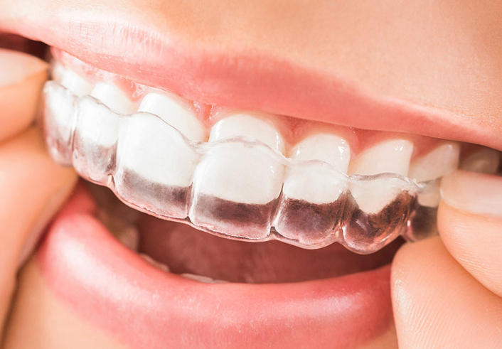 マウスピース型矯正装置