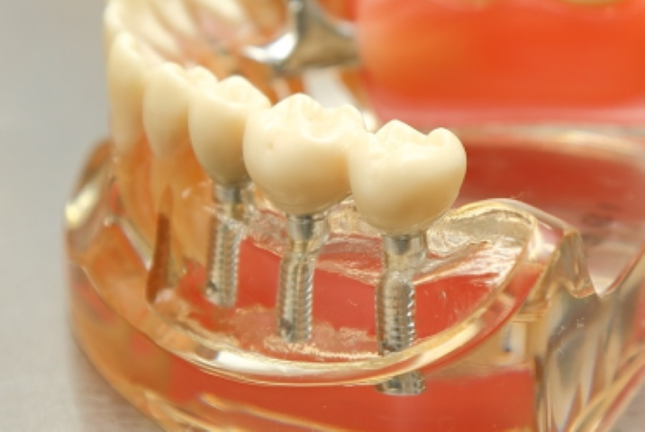 失った歯を補うインプラント治療で快適な毎日を