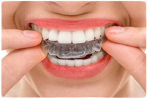 マウスピースを使用した矯正治療です