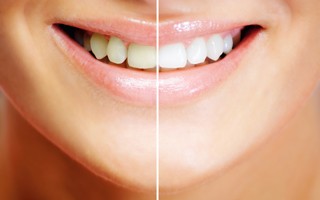 白い歯が叶うホワイトニング