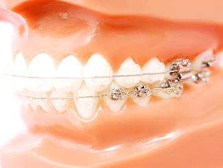 ブラケット矯正のイメージです。