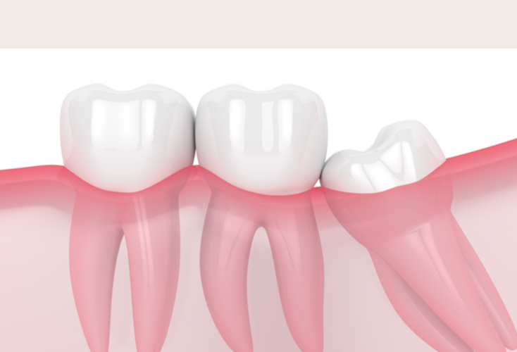ブラッシングしにくい為、虫歯ができやすい