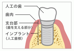 インプラントの仕組み
