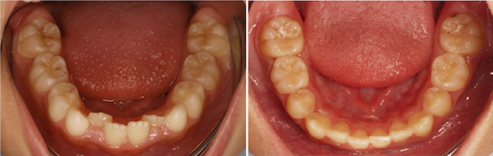 抜かずに整える自然な歯並び