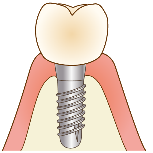 歯を失った方へ最善の選択を提供する長野フォレスト歯科の再建治療
