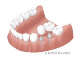 世界的に高い評価を受けるノーベルバイオケア社のインプラントを採用しています