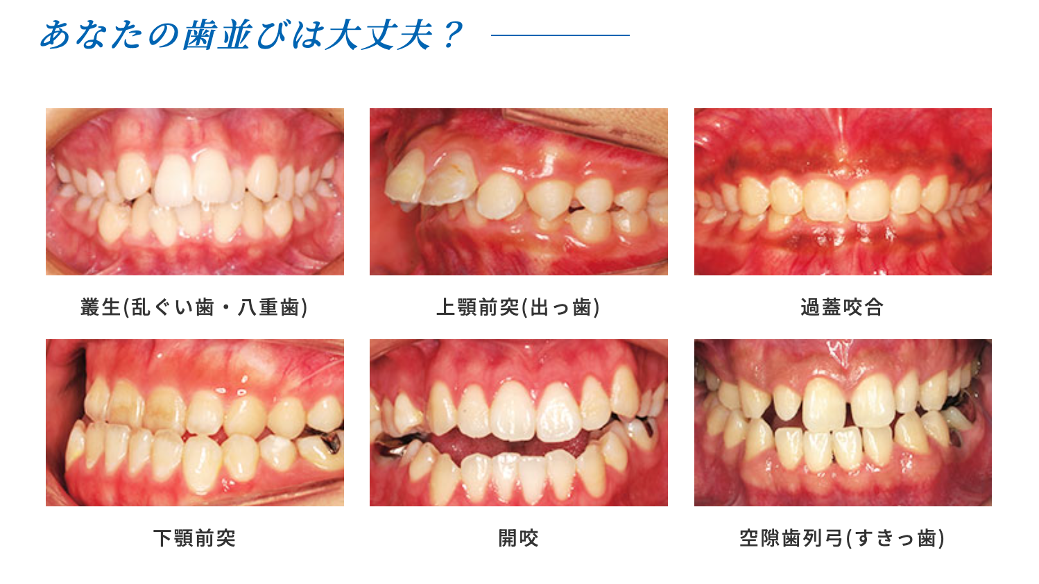 むし歯や歯周病、消化不良の原因となります