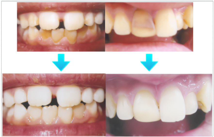 自宅で白い歯を作ることができます