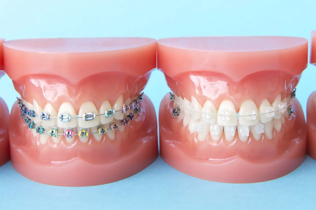 目立たないセラミックブラケットをご用意