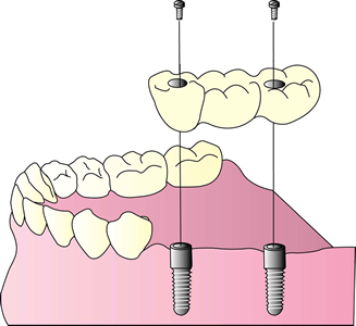 骨再生技術でインプラント治療の可能性を拡大