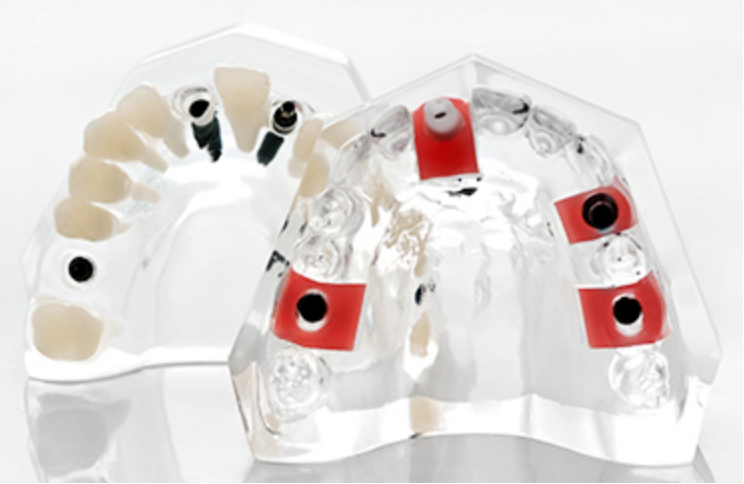 装着感・機能面ともに天然歯に劣らずストレスを感じさせないインプラント