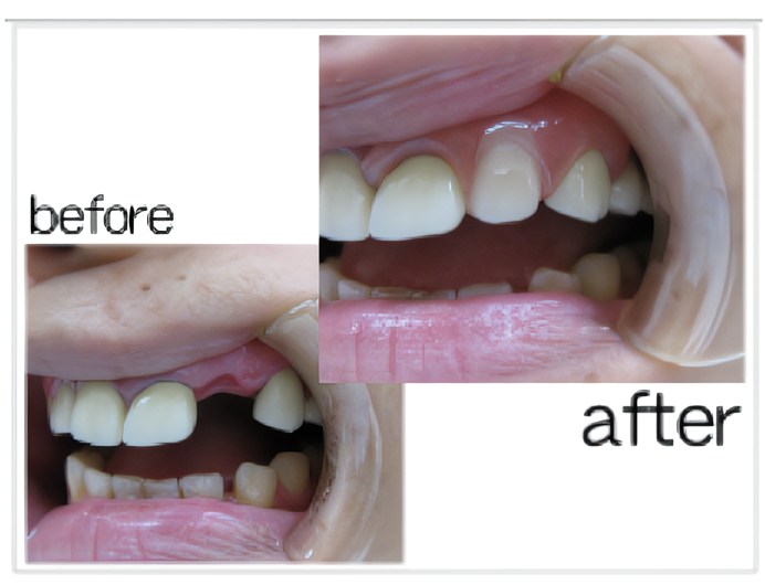 次世代の義歯を体験してみませんか