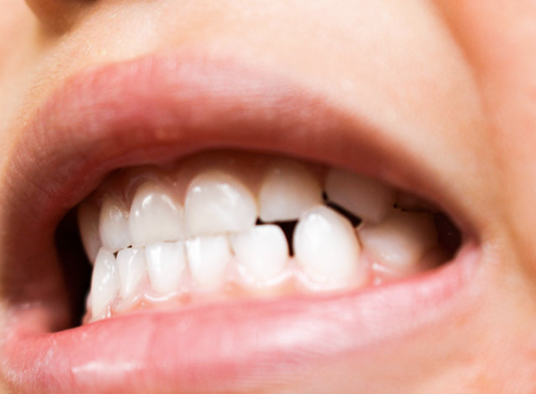 嚙み合わせが悪く食いしばってしまう様子