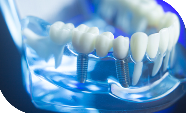 インプラント治療をお考えの方はぜひお気軽にご相談ください