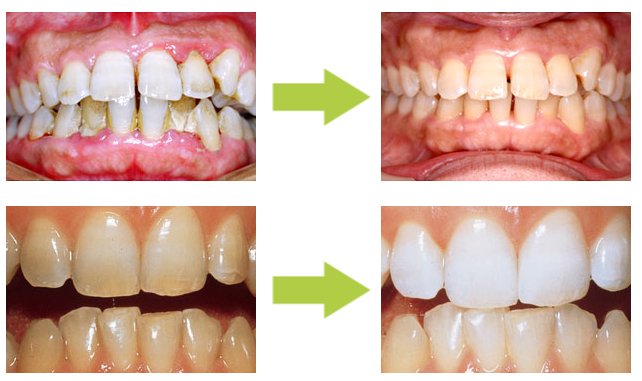 着色や黄ばみもこのように白くなります