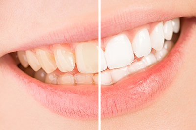 ホワイトニングやラミネートべニアで理想の笑顔に