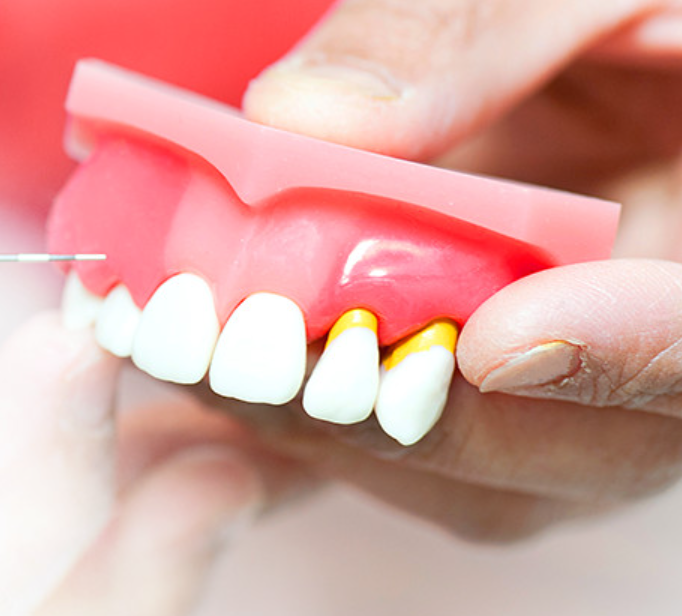 歯周病を放置すると深刻な状態になる可能性があります。