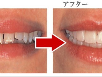ラミネート法のビフォーアフター