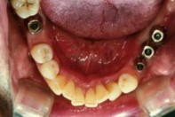 独立した歯として機能する点が大きな特徴です