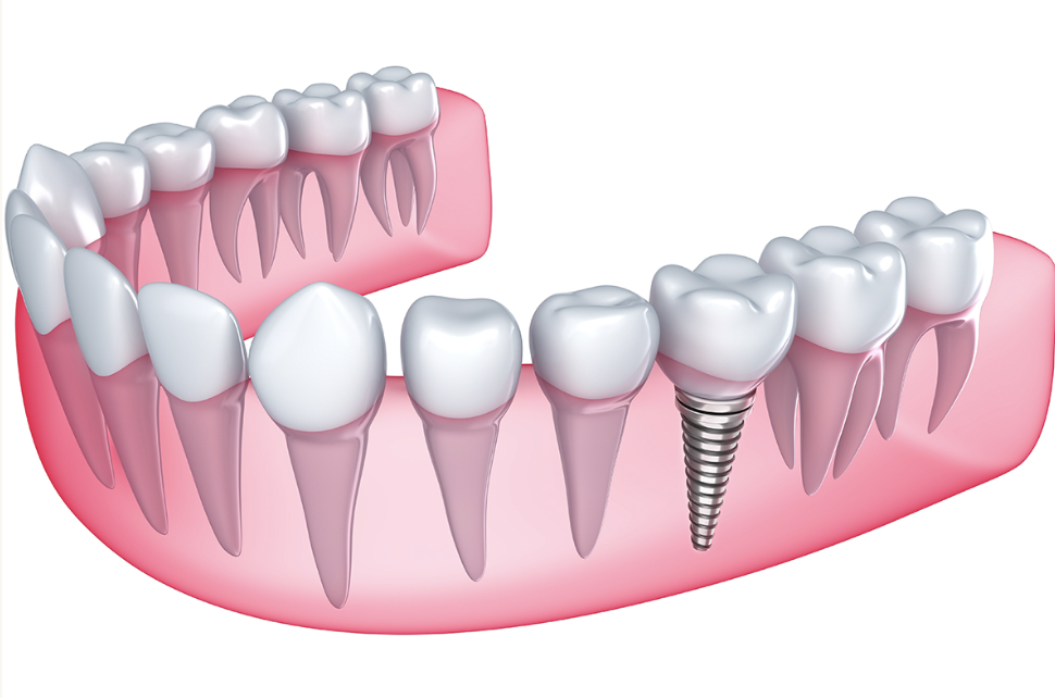 インプラントを歯を失った方の選択肢の一つとしてご提案しています