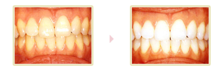 ホームホワイトニングにより白くなった歯