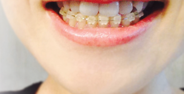 歯並びのお悩みをお聞かせください