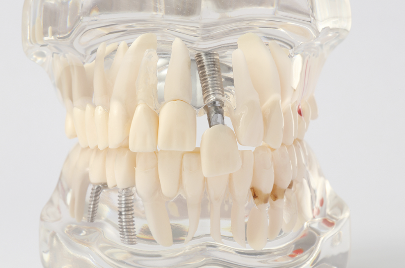 歯を失った方が自然な噛み心地と美しい見た目を取り戻せるインプラント治療を提供しています