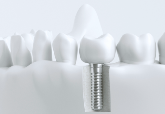 最新機器と丁寧な説明で、不安を取り除きながら進めるインプラント治療