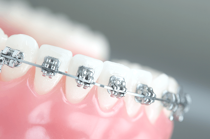 お子様から大人まで矯正治療が可能です