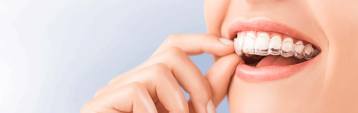 あおぞらデンタルクリニックの得意な診療—透明マウスピース矯正（インビザライン）