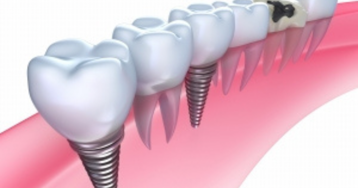 倉本歯科医院のインプラント治療
