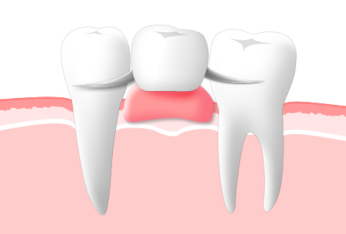 患者様に合わせた入れ歯で機能回復を実現します