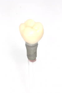 自然な噛み心地、インプラントで実現