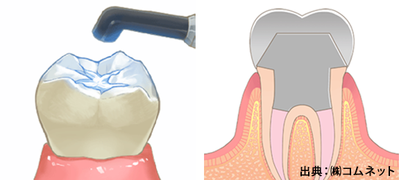 虫歯の治療後の歯の修復治療のしくみ