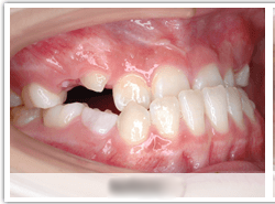 受け口の顔つきを残さないよう尽力します