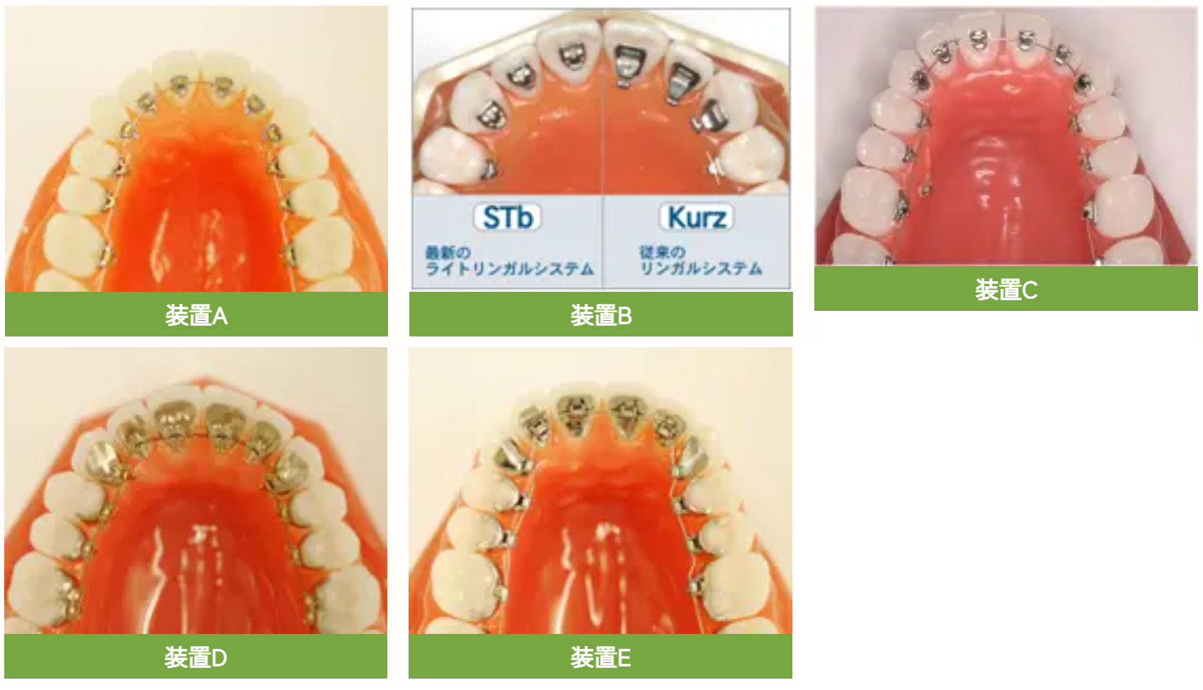 矯正装置にも様々な種類があります