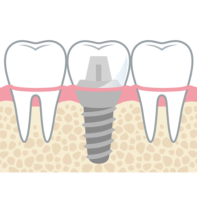 自然な噛み心地を取り戻すまきデンタルクリニックのインプラント治療