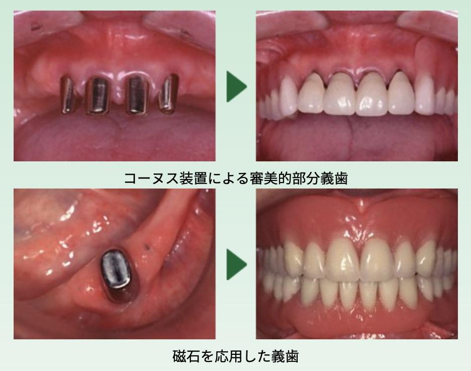 磁石を利用した義歯