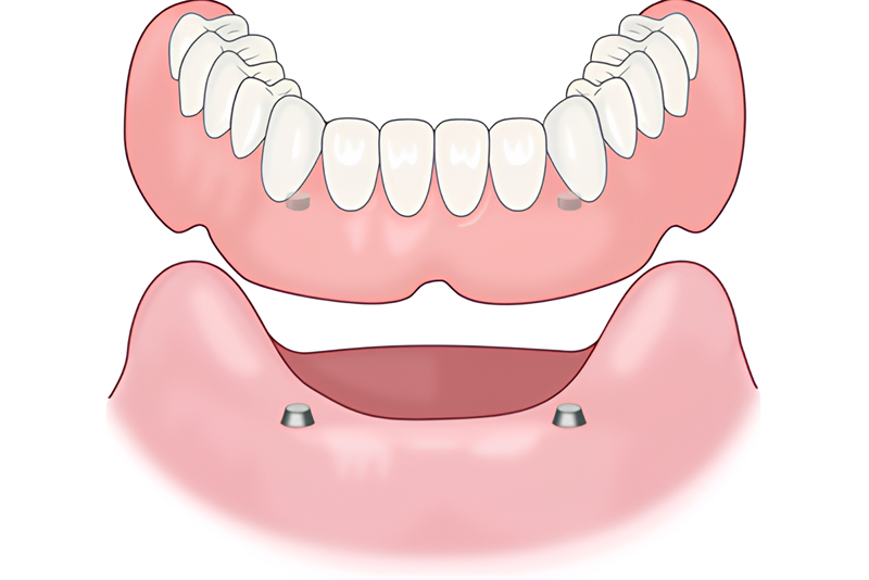 マグネットデンチャーなど多様な選択肢で患者様の生活の質を向上