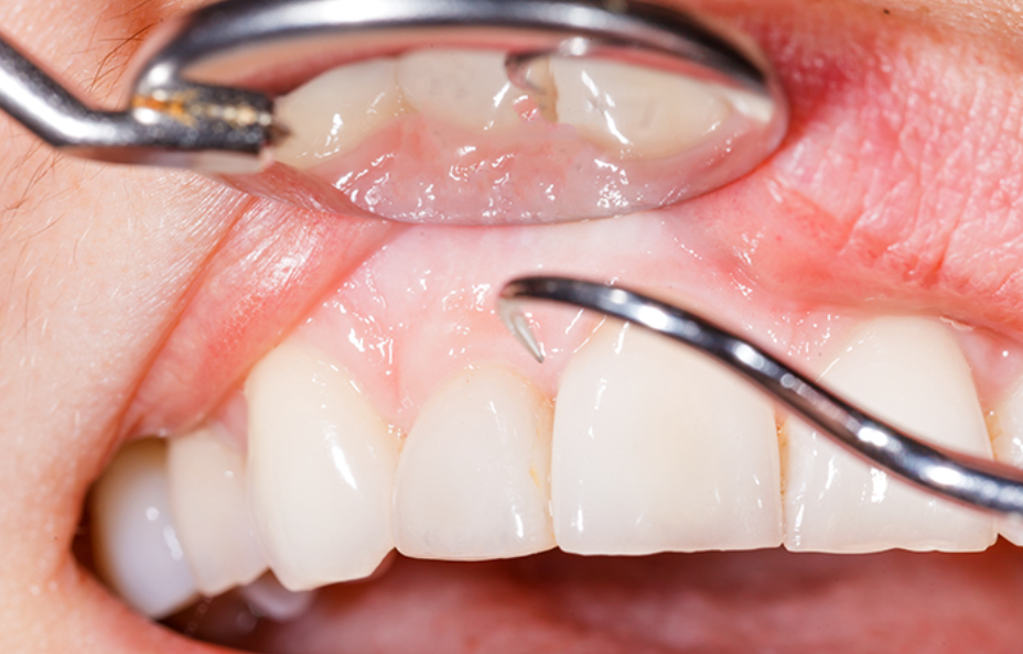 削る範囲を最小限に抑え歯の寿命を延ばす優しい虫歯治療